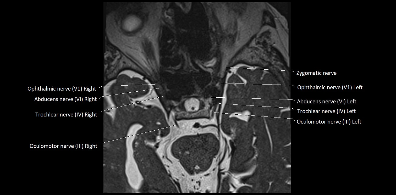 Cranial nerve anatomy axial MRI 3T image 25.webp